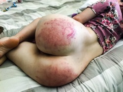 submissivewildling:12 hours post impact and bruises are still developing.  It’s always a problem when my sub side loves to be beaten and then I wake up in little space all teary and sad because my bum hurts.