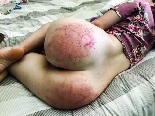 submissivewildling: 12 hours post impact and bruises are still developing.  It’s always a problem when my sub side loves to be beaten and then I wake up in little space all teary and sad because my bum hurts.