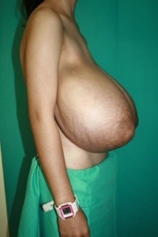 Real Life Big Breasts #8Macromastia Medical Photo - Patient with a 55 inch bust and