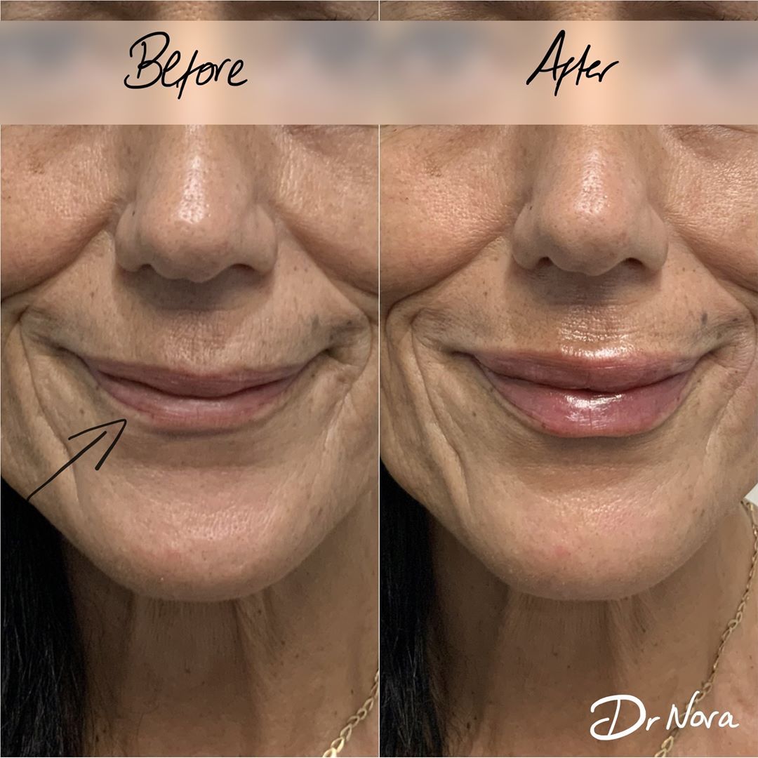 1ml lip filler 👄Treatment time is around 20 minutes and swelling and bruising is seen straight after settling at around 3-5 days with optimal results at 2 weeks. Results are expected to last from 6-9 months.
If you’re interested in finding out more...
