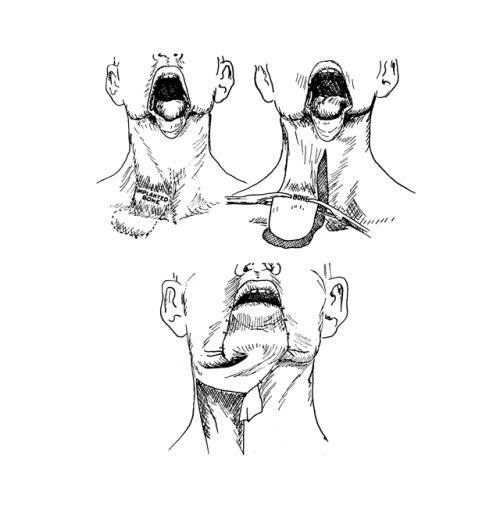 Method of closing a defect in the mandible and reconstruction of the lowerlip at the same time, Plas