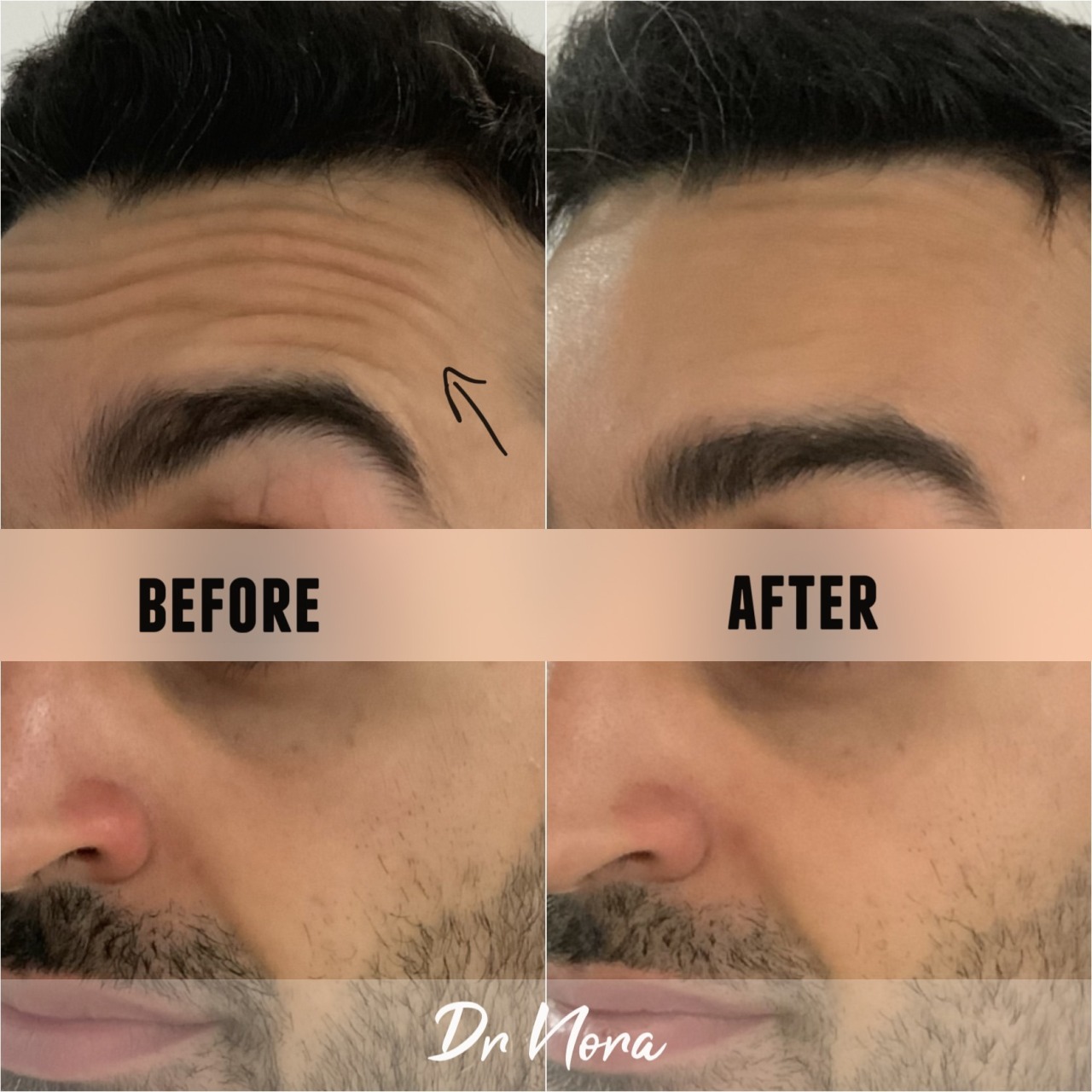 Anti-wrinkle treatment of the forehead 😲Anti-wrinkle therapy is a way to reduce the appearance of strong and deep lines. Treatment time is 15 minutes, optimal results are seen at 2 weeks and lasts up to 3-5 months.
If you have any questions or would...