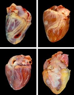 Shot in the heart Heart of someone with cancer Heart after drug overdose Heart of an obese person 