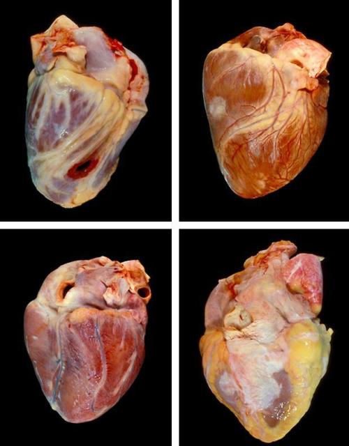 Shot in the heartHeart of someone with cancerHeart after drug overdoseHeart of an obese person