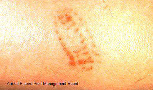 Hives allergic reaction skin rash