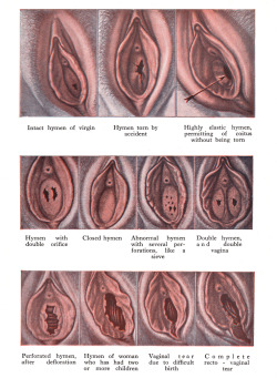 kronstadt21:  Know your hymen. From the Encyclopedia of Sex Practice, Norman Haire, 1953 reprint. First published in 1938. Vintage Scans