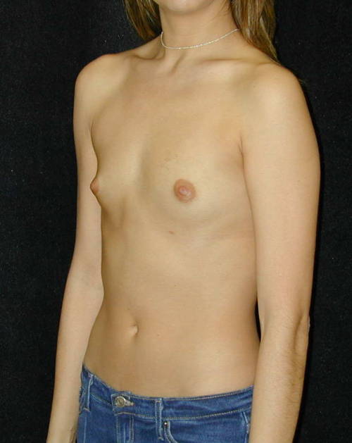 sexyflatchested: Breast augmentation pre-op photos.  Too bad they ruined some nice tiny tits wi