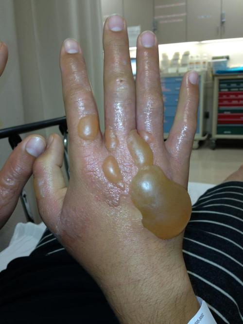 Totally gross, right? It&rsquo;s not SFX makeup. It&rsquo;s my coworker&rsquo;s hands. He squeezed s