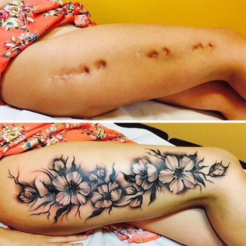 greeneyes-anddimples:pr1nceshawn:Tattoos That Turned People’s Scars Into Works Of Art.I’