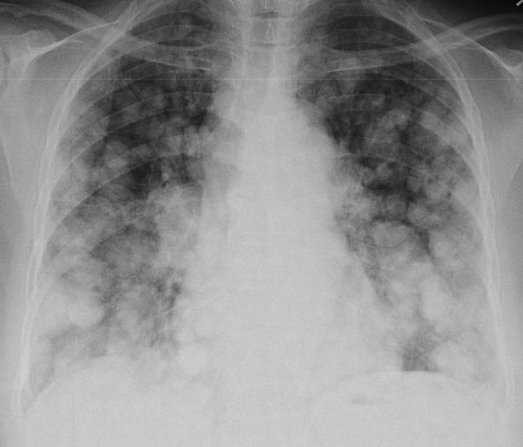 cranquis:  surrealmeds:  The Case of The Riddled Lungs As you go through medical