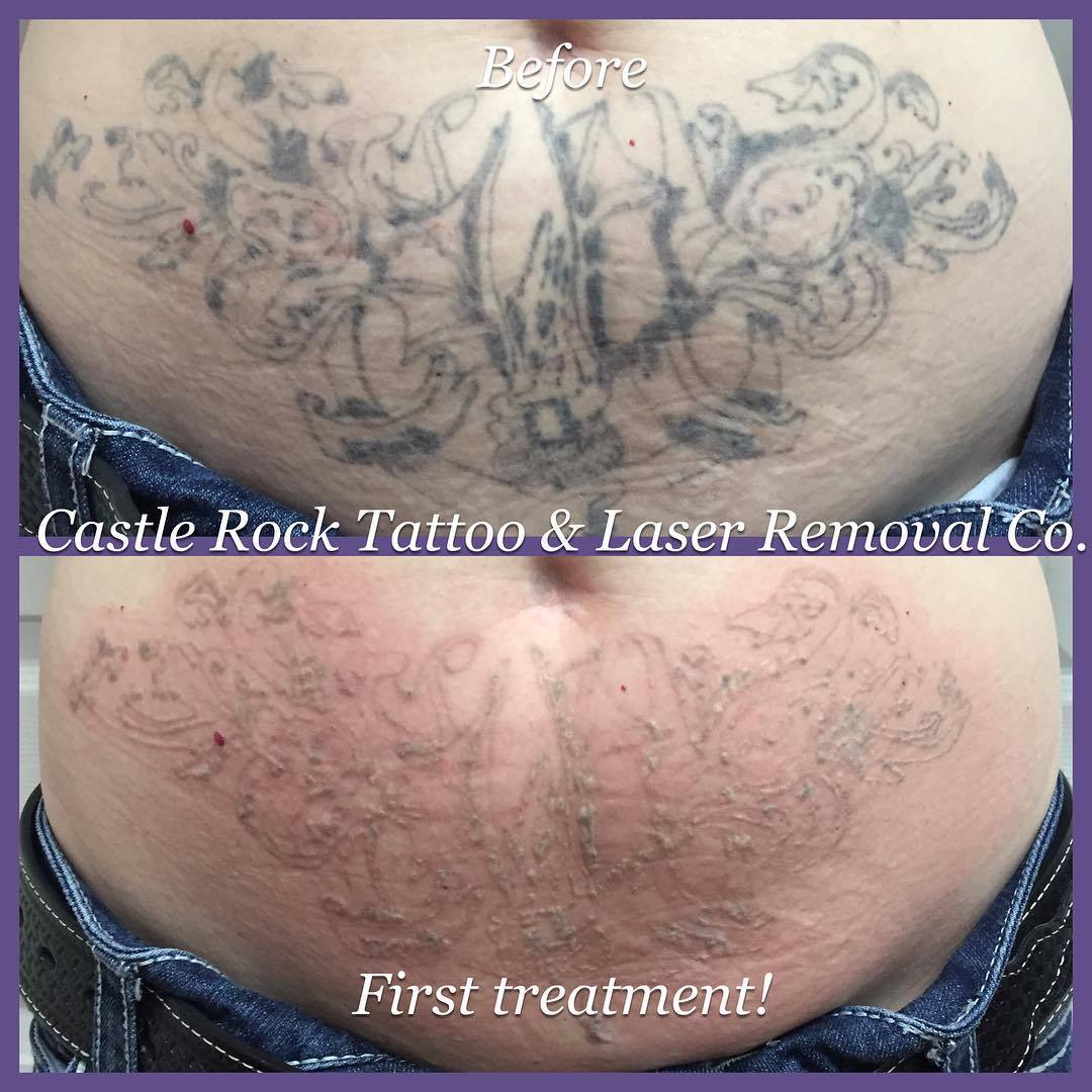 Tattoo Removed from Womans Stomach Before  After Photos New Jersey   Reflections Center