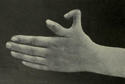 Supernumerary Thumb, From Edward M. Foote’s A Text-Book Of Minor Surgery, 1909