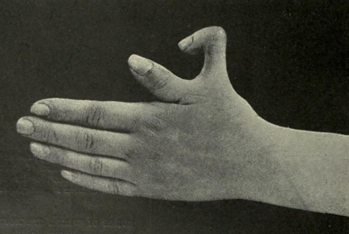 Supernumerary thumb, from Edward M. Foote’s adult photos