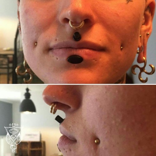 Philtrum-scalpelling I did a few weeks back. Picture is 10 days into healing. Size is 4 mm TRAVELLIN