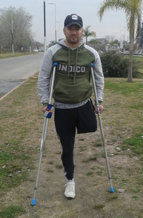 akcrutcherdev: Awesome shot of newly amputated one-legged boy — identifying as a crutching cri