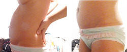 budtx300:A nice before and after bladder distention from the web.