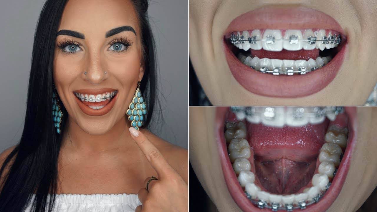 All About Braces — Watch How We Put Your Braces 