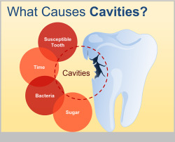 The-Oral-Health:  #Cavities !