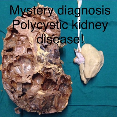 iheartautopsy:This kidney was more than 7 pounds!!! Compare that to the normal size of a kidney whic