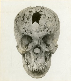 Syphilis of skull