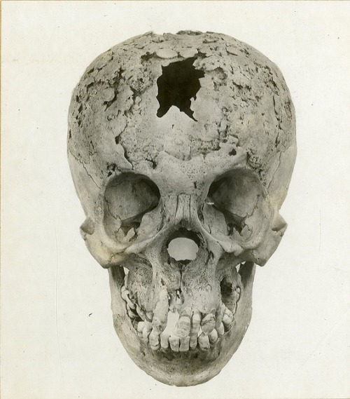 Sex Syphilis of skull pictures