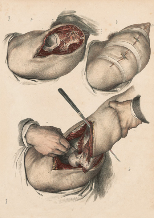 Traité complet de l'anatomie de l'homme: comprenant la médicine opératoireDigit