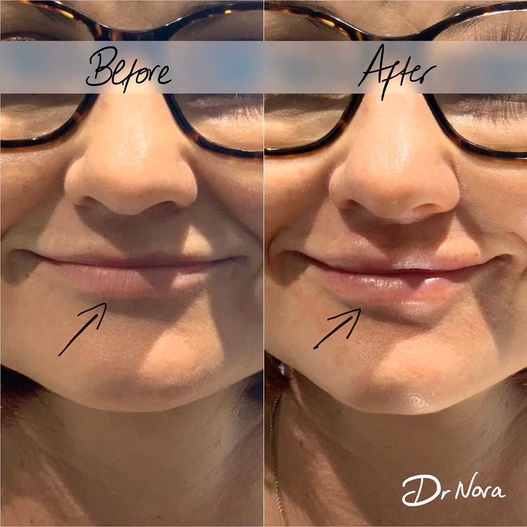 1ml lip filler 👄Treatment time is around 20 minutes, swelling and bruising is seen straight after settling at around 3-5 days with optimal results at 2 weeks.
If you’re interested in finding out more or to book, head over to drnora.com.
Take care and...