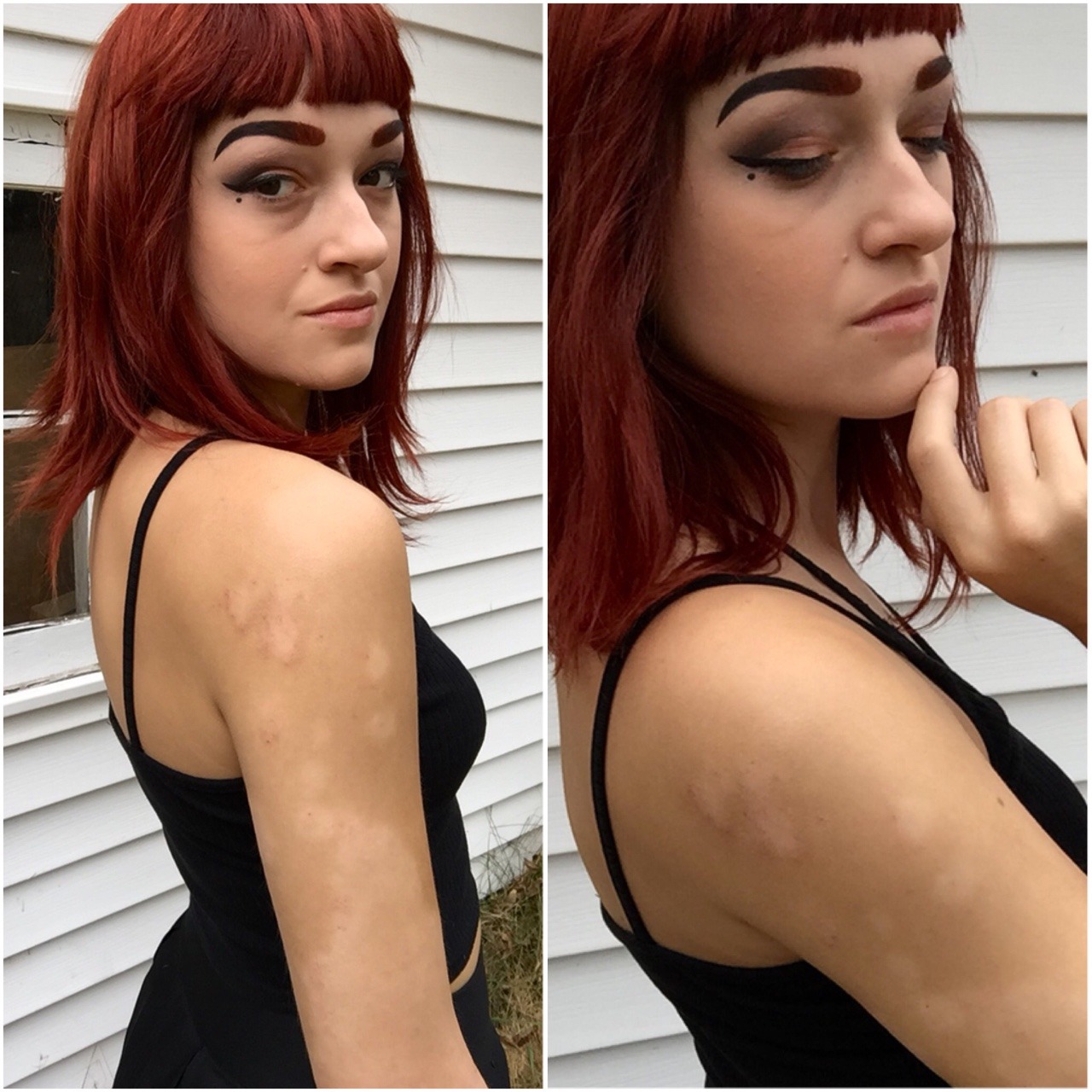psoriasis psucks! psoriasis psucks!
