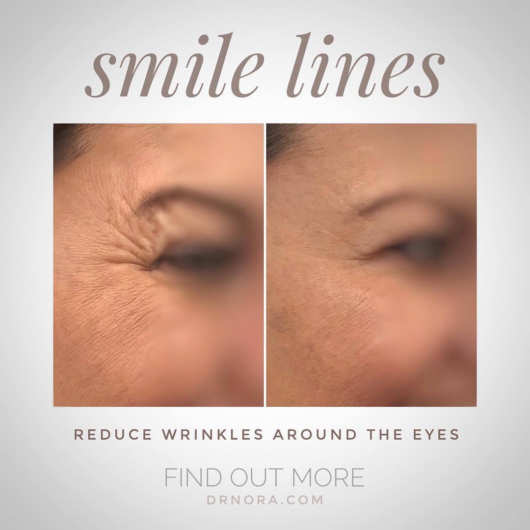 Reduce wrinkles around the eyes ðŸ‘€This lovely lady had a great response from anti-wrinkle treatment. Not only did it help to reduce those deep and soft lines but it’s also helped to open up her eyes, giving a fresher appearance ðŸ’‰ðŸ‘� Anti-wrinkle therapy...