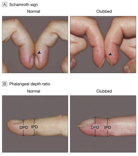 Dream NExT - Normal finger vs. clubbed finger Lovibond angle is an angle  located at the junction between the nail plate and proximal nail fold, and  which is normally less than 160