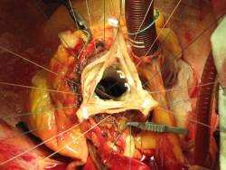 medicalschool:  Open Heart Surgery 