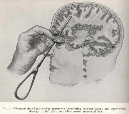 Dr. Walter Freeman and the Ice Pick Lobotomy,During the late 19th and early 20th century many doctor