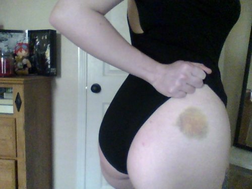 Sex ero-hime:  bruise  pictures