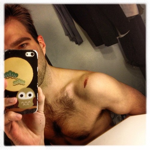 zacharyquinto: my broadway de-booboo is healing up.