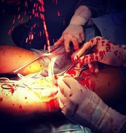 doctordconline:  Rupture of Artery during Surgery… ❤️ if you think it’s fascinating… #surgery  #surgeon  #operation  Courtesy: surgMedia #doctor #doctordconline #usmle #pathology #anatomy #mbbs #usmlestep1 #md #medicine @doctordconline #amc