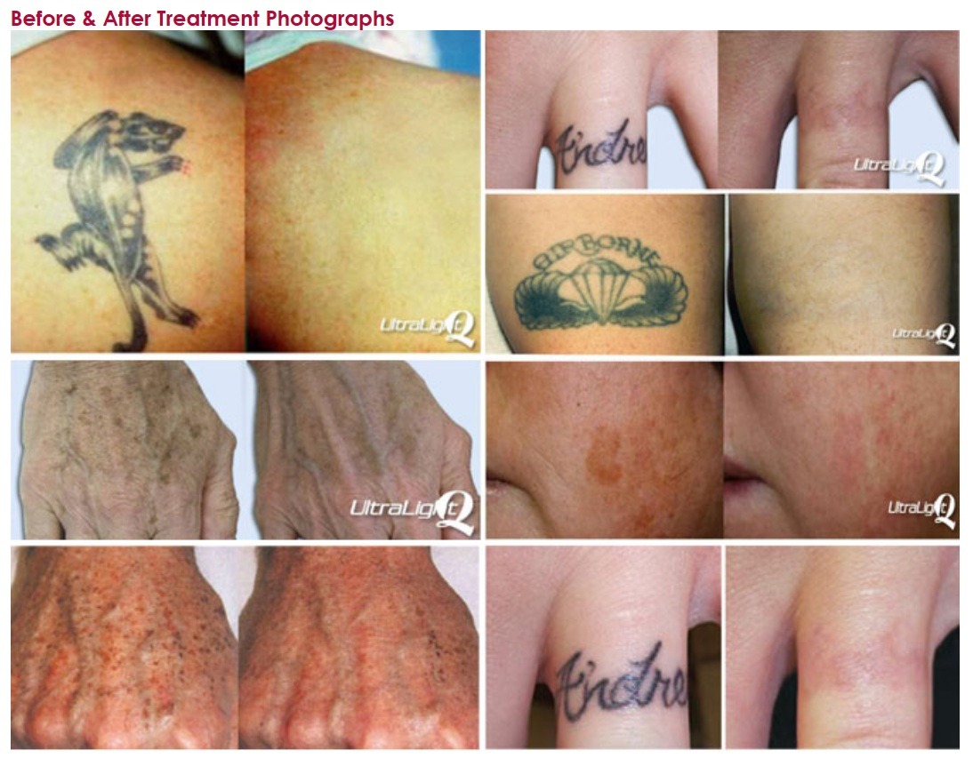 What is Laser Tattoo Removal?
About 25 percent of the United States population has a tattoo, and of that, about 50 percent later regret their choice to get inked. Getting a tattoo was always one of those things that our parents warned us about. “It’s...