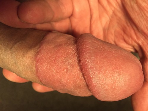 cutesoutherngay: cutguyscuteguys: Such an amazing cock!tightlycut:I was circumcised exactly five mon