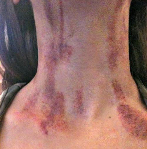 all about bruises