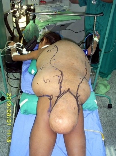 Large tumor in the neck, stretched across the back, accompanied by a scoliotic deformity which ended in a tail.