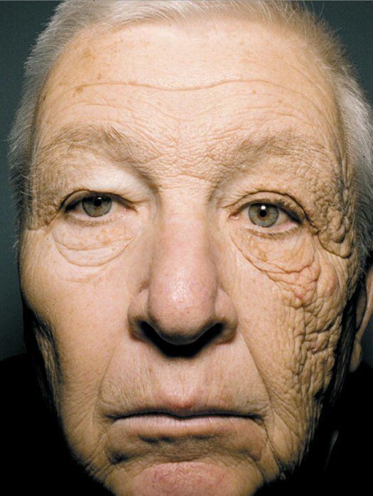 sixpenceee:  This image from the New England Journal of Medicine shows the effect