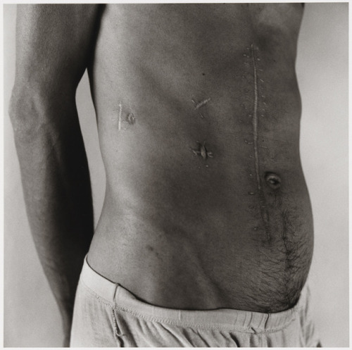 tomakeyounervous:  Pascal: Scarred Abdomen, 1980 ph. Peter Hujar 