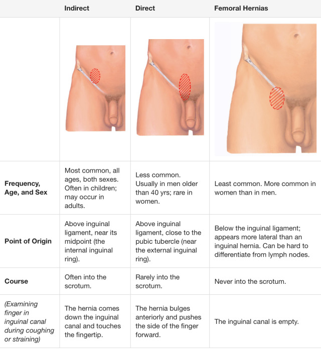 What is the Difference Between Inguinal Hernia and Femoral Hernia