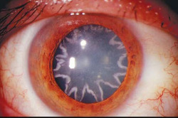 pizzahutofficial:  A 42-year-old electrician got star-shaped cataracts after being shocked by 14,000 volts. 