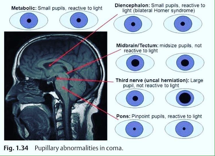 doctordconline:Pupillary Abnormalities in Coma.. #coma  #pupil  #ophthalmology #surgery