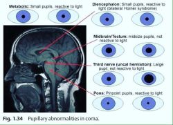 doctordconline:Pupillary Abnormalities in Coma.. #coma  #pupil  #ophthalmology #surgery  #neurosurgery #icu #mri #ctscan #neuroscience #gcs #pathology #anatomy #ms #mbbs #usmle #usmlestep1 #doctor #doctordconline #nhs #nurse #nursing #medlife #amc #plab