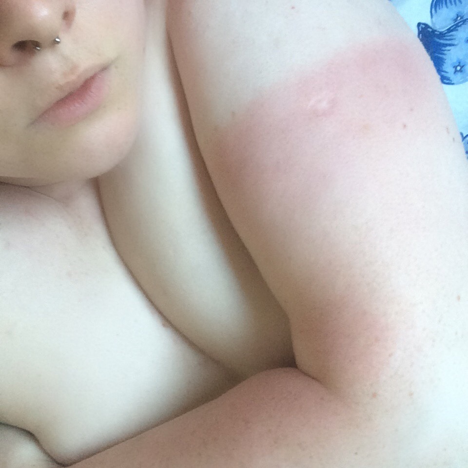 brokenheartedgoodgirl:  I stupidly caught the sun. It’s hard being so lily white.