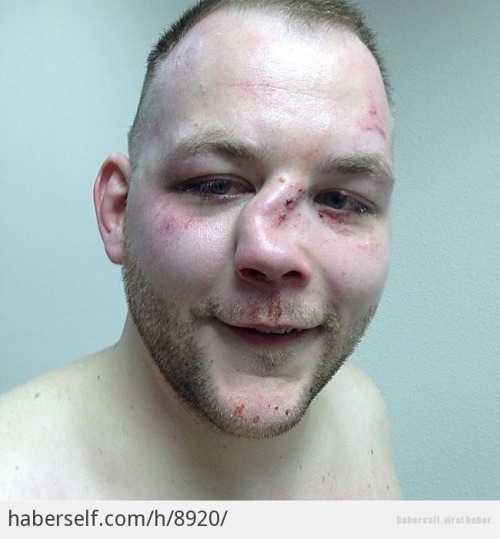 Mma fighter broken nose