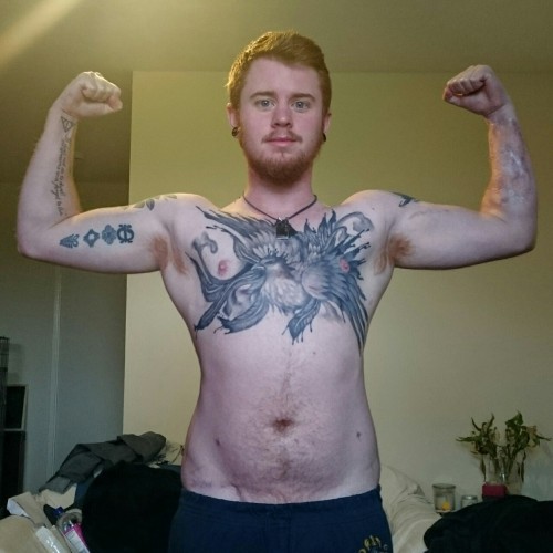 accio-aj:  3 years 1 month on testosterone. 2 years 5 months post chest surgery. 1 year 2 months post 1st stage forearm phalloplasty. 8 months post 2nd stage phalloplasty. 2 months post 3rd stage phalloplasty. 2.5 weeks post unfortunate testicle rejection