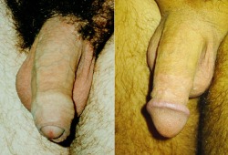 travellersprivate:Circumcision - before and