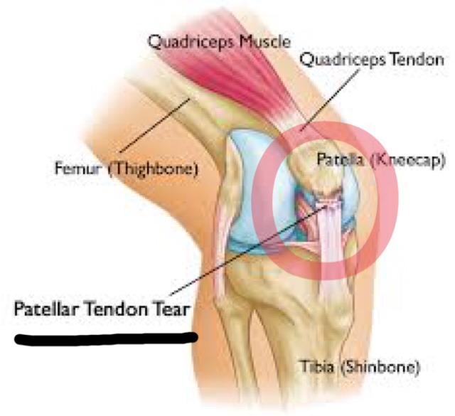 Just Well Sports Medicine Center 關於林書豪的髕骨肌腱斷裂 Patellar Tendon Rupture